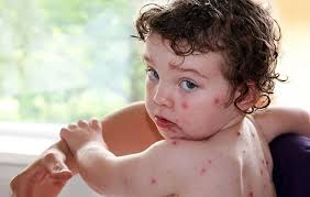 آبله مرغان چیست chicken pox تعداد 30 اسلاید ppt